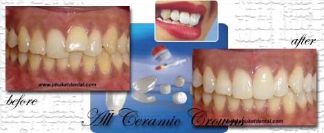 all ceramic crown